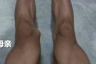 17岁体育生左膝长骨瘤医生错切右膝 回应称系