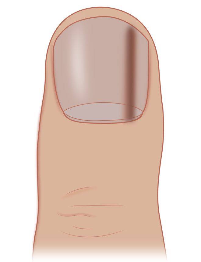“痦子”也会长在指甲上？