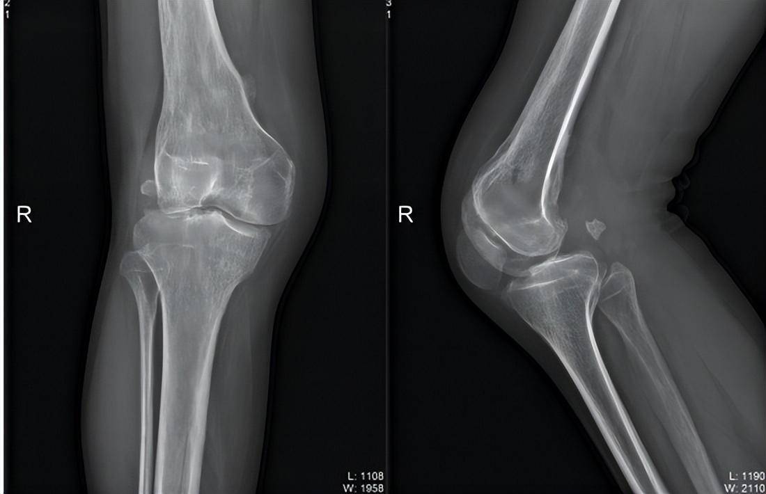 苏州高新人民医院关节外科成功为脊髓灰质炎患者进行膝关节置换