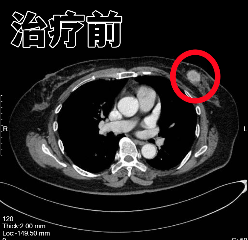 病例分享 ▏乳腺恶性肿瘤 如今肿瘤消失指标一切正常(图2)