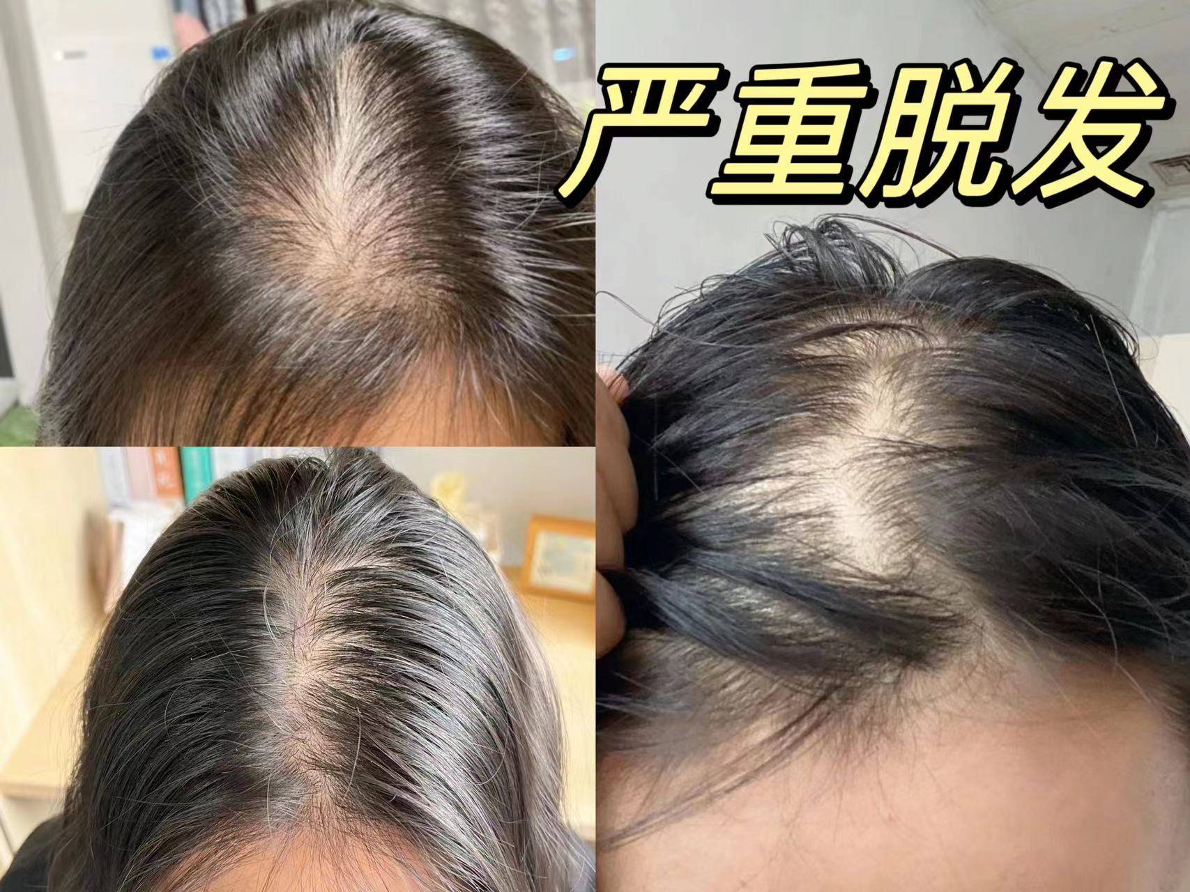 发缝宽、发际线高的离谱！姐妹们还有办法解决吗？