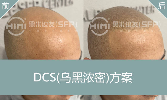 了解秃顶纹发操作方法，看秃顶纹发如何改变秃顶脱发形象