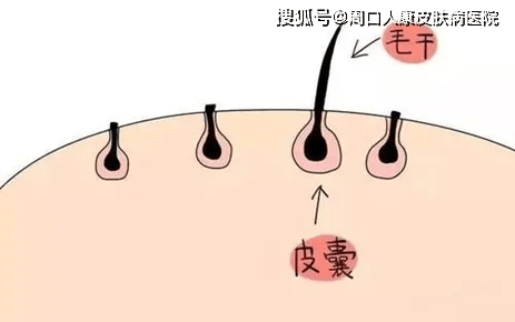 【周口人康皮肤病医院】毛囊炎的症状有哪些？什么原因引起的呢？