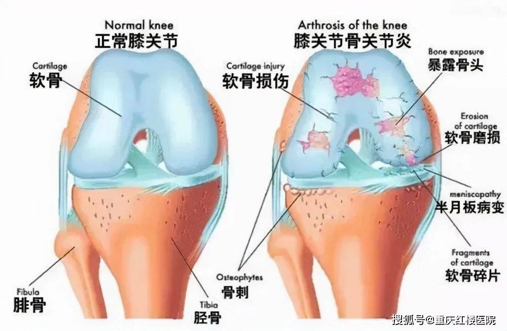 膝盖受凉就疼痛是怎么回事？有什么办法缓解吗？