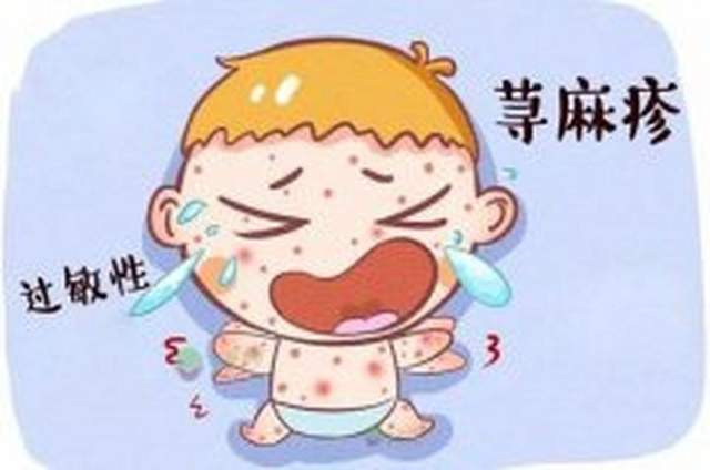 原创              夏季荨麻疹高发期，3类因素容易患病，出现这些症状及时就医