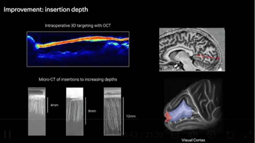 马斯克脑机接口公司重大突破，1.5秒快速植入电极，万人等待上脑