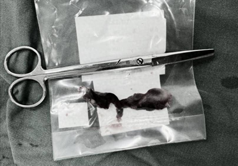 月经淋漓不尽，别只当内分泌失调，可能是宫颈息肉作祟！