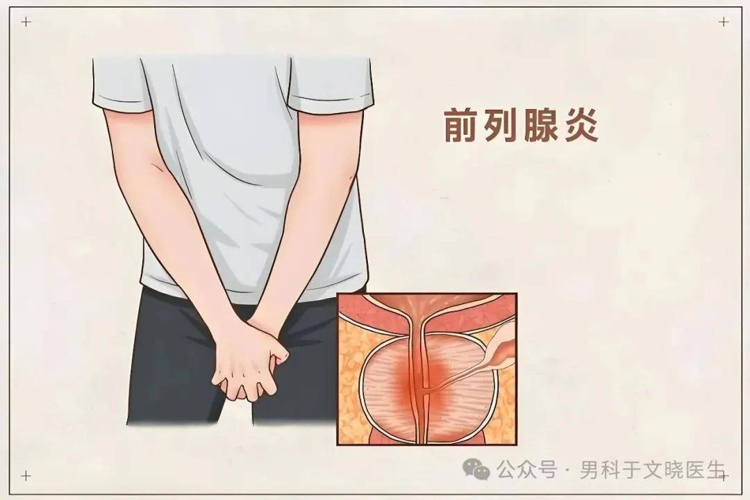 
        前列腺炎反复发作，到底是没治好，还是根本不是感染？