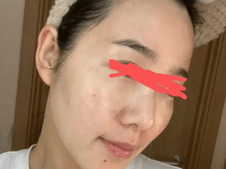 不看吃亏！生理盐水竟能搞定多年痤疮痘痘！痘肌友友赶紧码住！