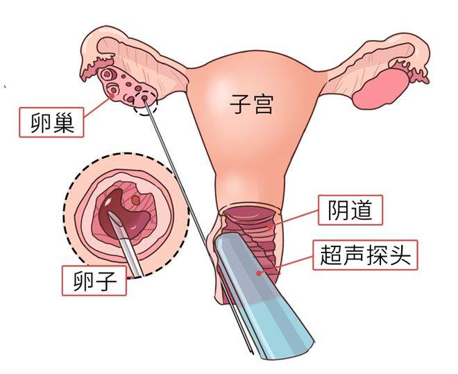 深圳生殖医学中的供卵技术：突破与展望