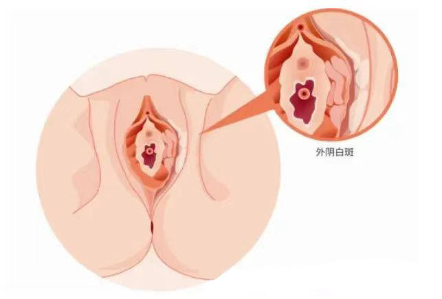 贵阳附大-妇科白斑医学研究:外阴白斑与私处瘙痒的真相
