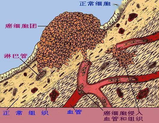 能是几周的时间发现一倍的肿瘤,因此这种类型的肿瘤发现后必须尽早治疗。