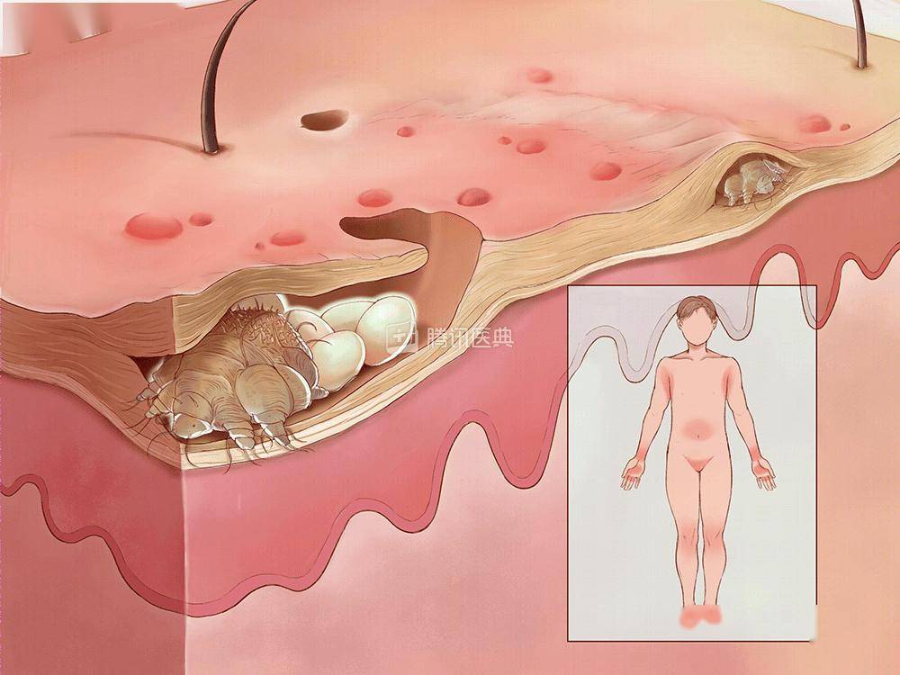 夜里痒到怀疑人生,原来是有虫子在我皮肤里挖洞产卵