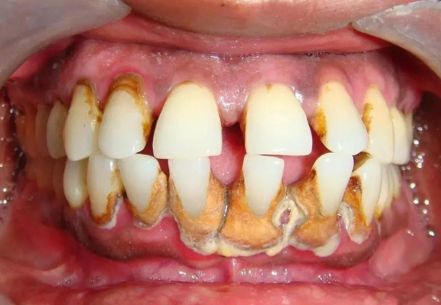 牙黄牙结石有福了!这几款牙粉用完牙齿直接白得反光!不看血亏!