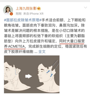 扒一扒:小拉皮手術切口圖片?做面部拉皮的最佳年齡?變