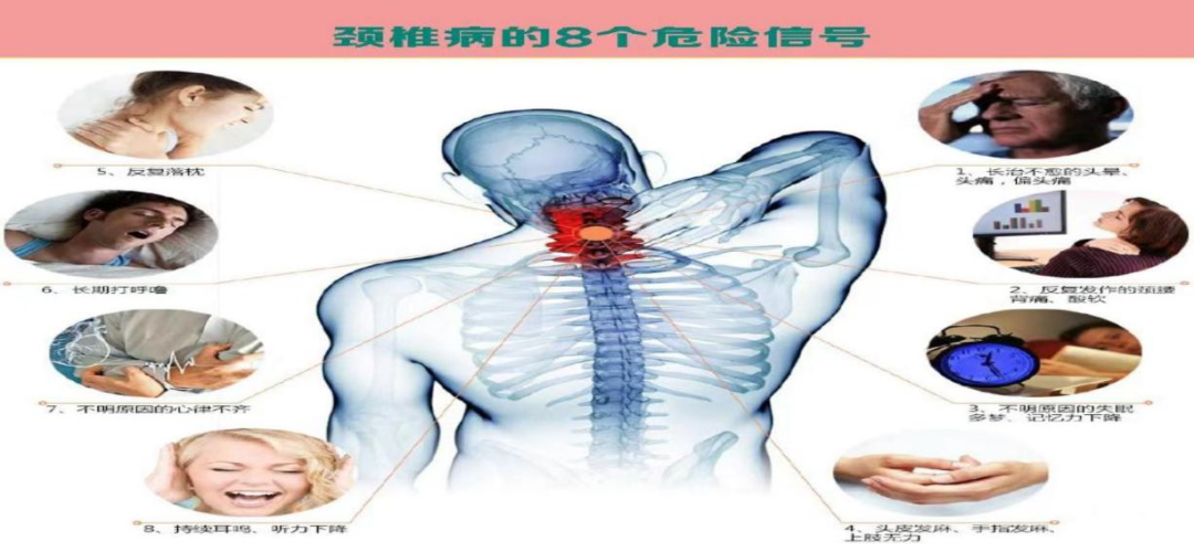 混合型頸椎病,通常是以某一型的臨床表現為主,伴有其他類型的部分表現