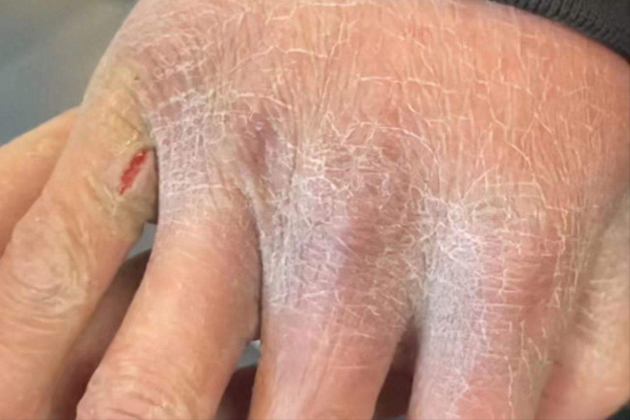 一招搞定手掌粗糙干裂!这个润肤方法真的牛!错过后悔!