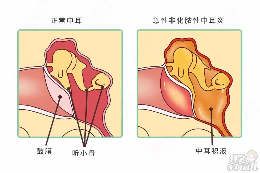 儿童急性中耳炎会有哪些症状表现？