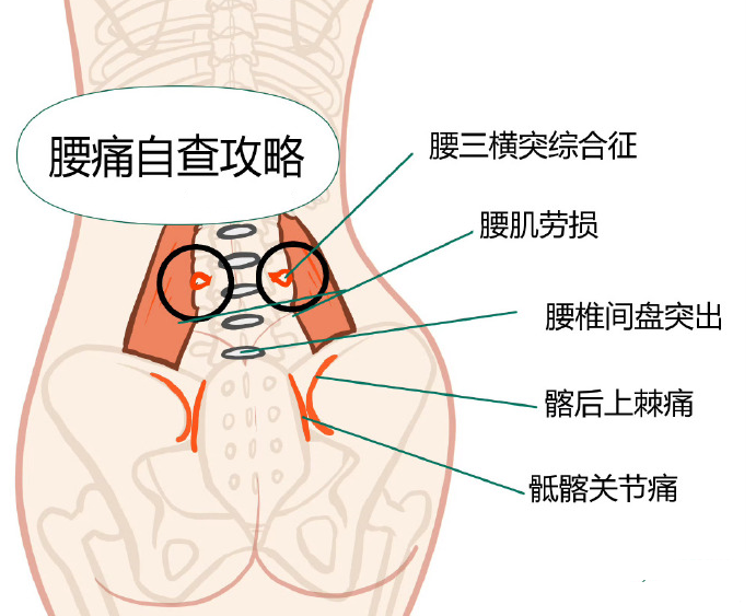 運動還是休息更有利於恢復?_腰椎_進行_坐骨