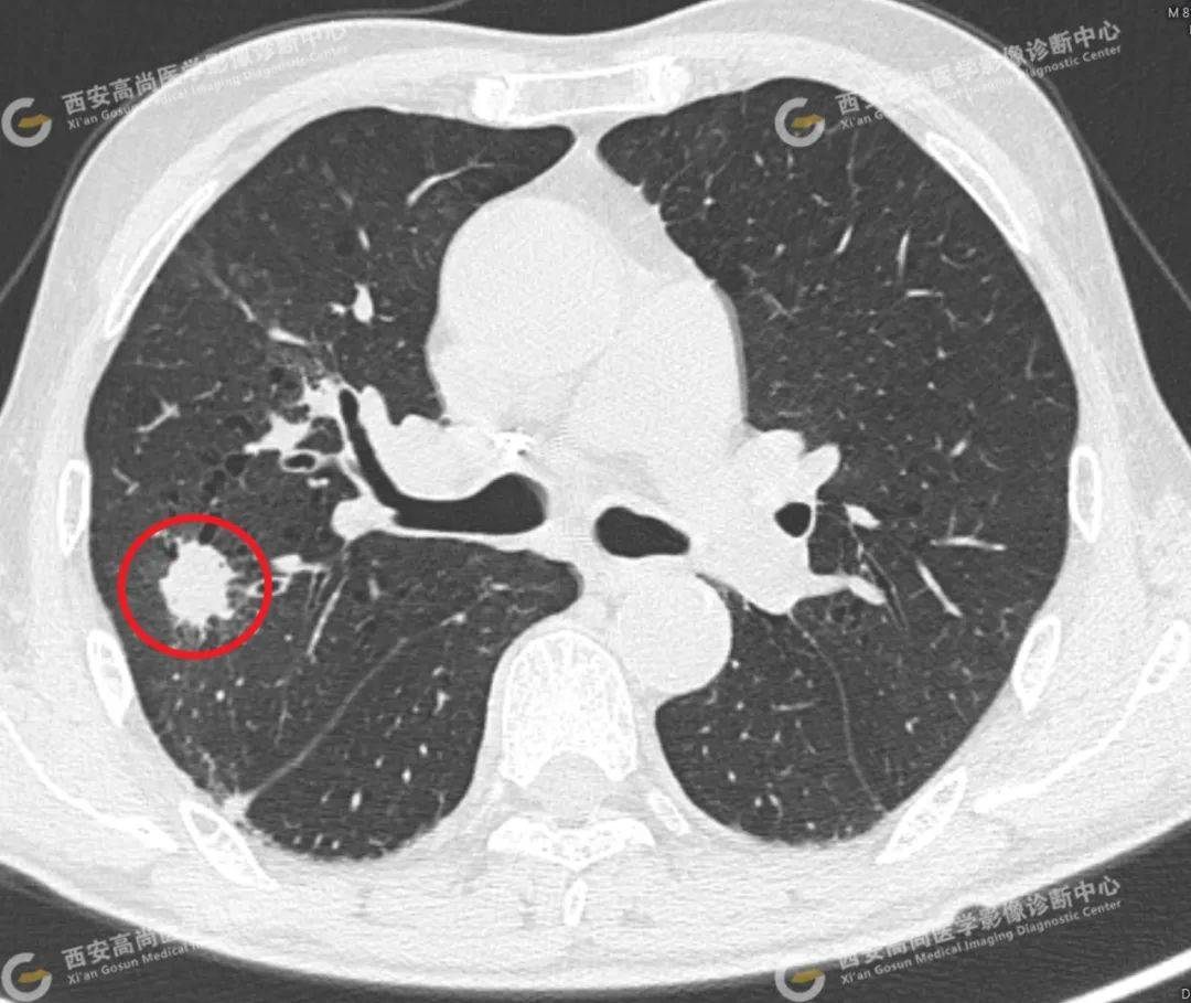 肺结节病灶图片