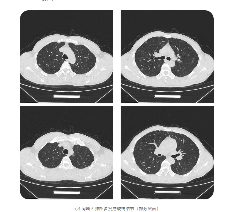 37岁男子查出557个肺结节,其中26个高危!