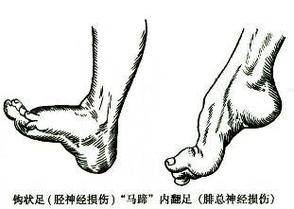 腓浅神经损伤图片