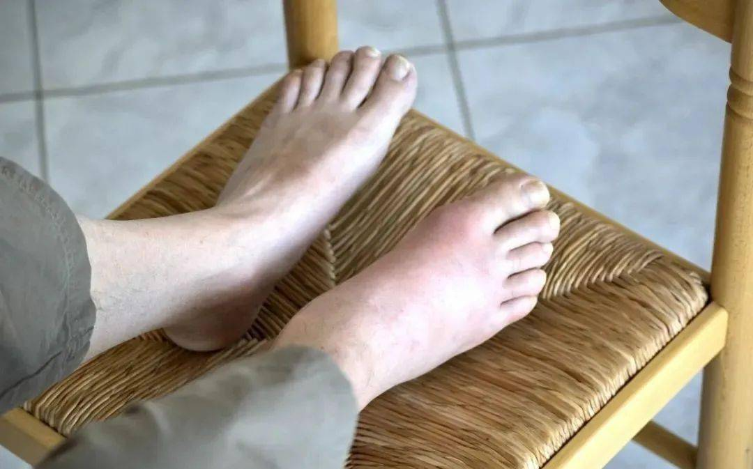 别以为年轻人不会得痛风_尿酸_饮食_患者