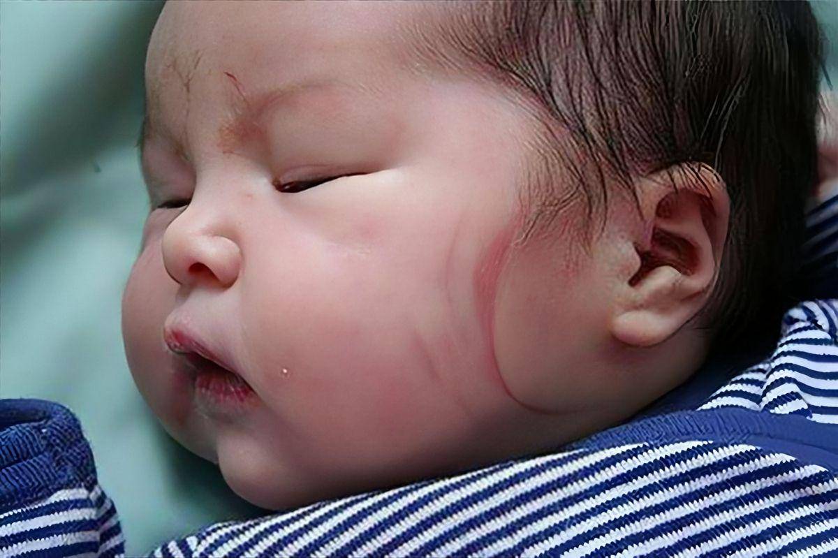 为什么有的宝宝出生时脸上有两道印迹(准妈妈如何避免产钳印的产生)