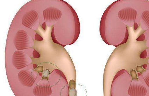 腎結石的症狀有哪些_輸尿管_飲食_蜂蜜