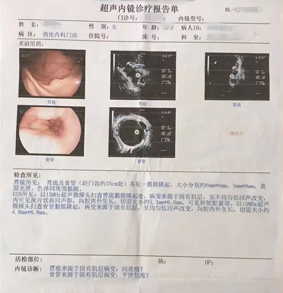 胃间质瘤超声图片