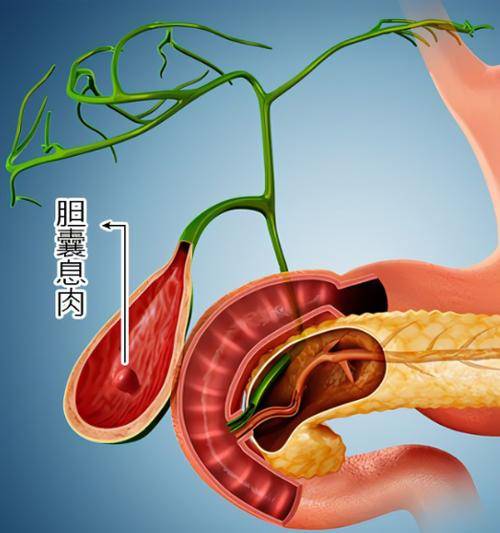 胆囊息肉是怎么引起的图片