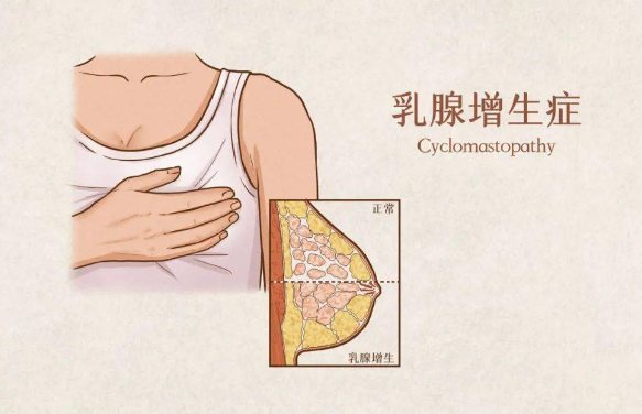 乳腺增生是一种生理性或病理性的乳腺组织反应,其主要症状包括乳房