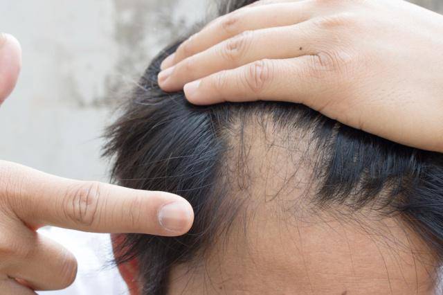 治疗~深圳永保健康智慧生发核心技术——毛囊克隆采用自体毛囊再生