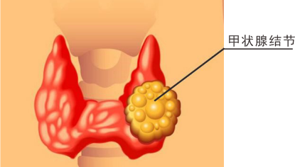 甲狀腺結節是甲狀腺組織內的一小塊異常增生的區域,通常是良性的,但