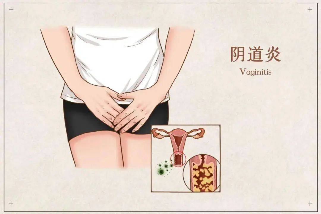 女性分泌物图片尿道图片