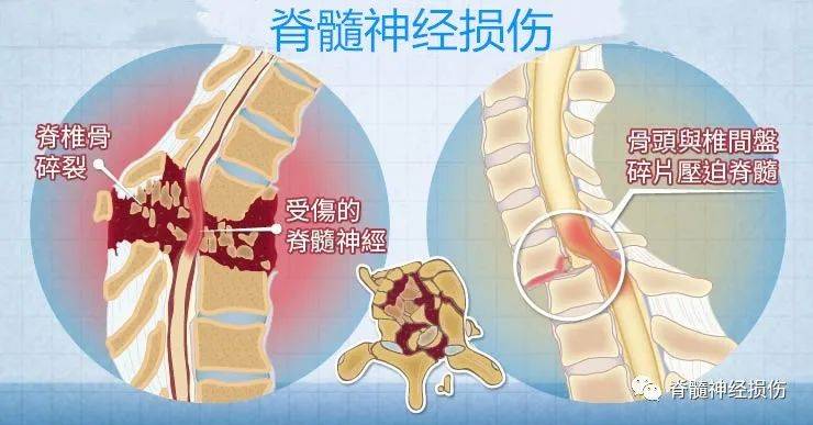 脊髓神经损伤的病因病理