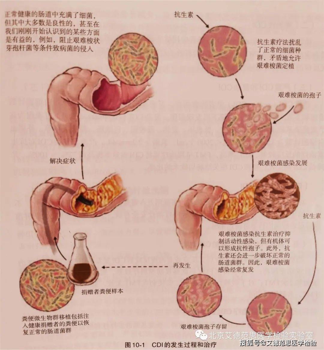 首先是筛选合格的供体,采集供体的粪便,规范制备出粪菌悬液,然后将粪