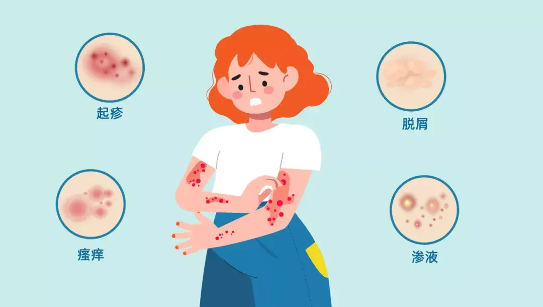 【免费临床】特应性皮炎新药临床试验:ox40l单抗ibi356