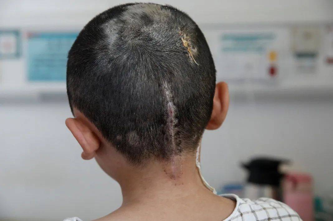 11岁儿童走路不稳伴头痛呕吐,原来是脑袋里面长"东西