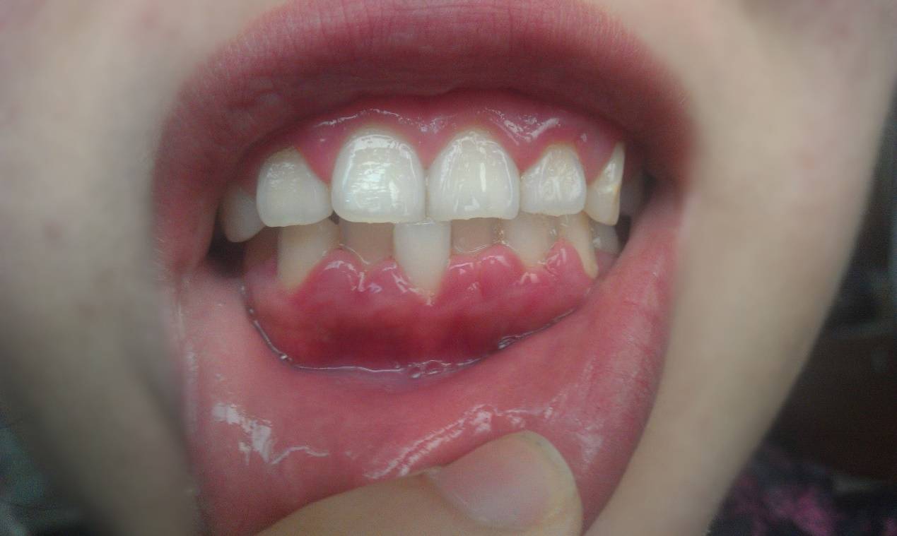 小孩牙周炎脸肿图片图片
