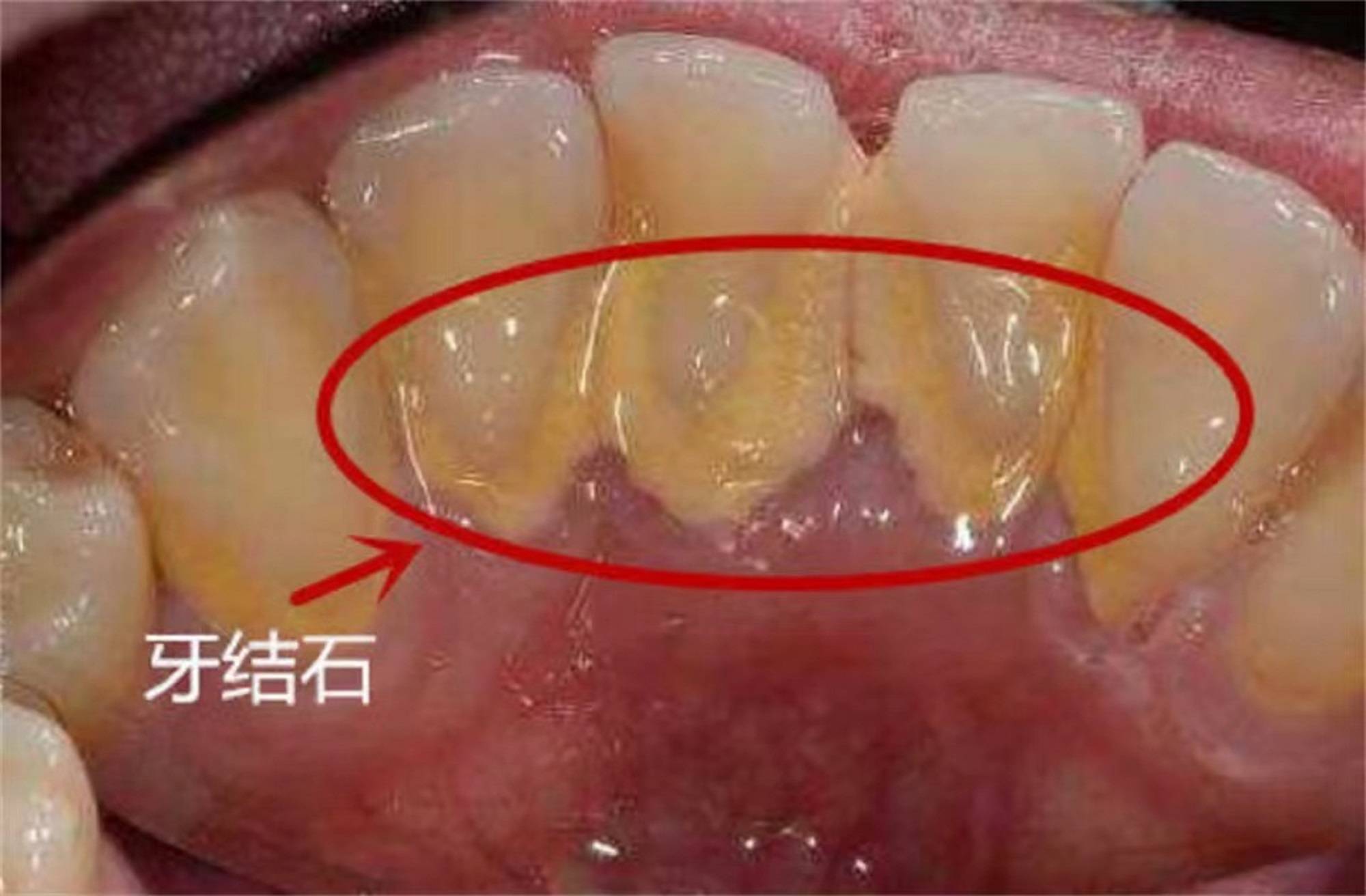 牙垢牙石别用手抠了!2个小妙招,让"脏牙垢"自动往下掉!