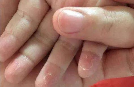孩子手脱皮是什么原因引起的?_皮肤_维生素_食物