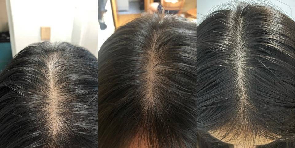职场秃党发量护理routine_头皮_头发_脱期