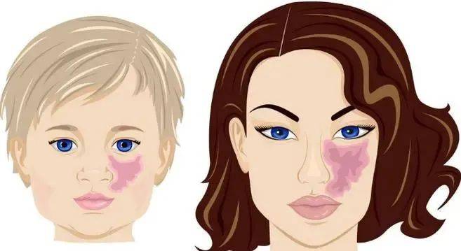 【沈阳肤康疤痕科普】葡萄酒色斑这样治疗更简单_疗法_患者_方法