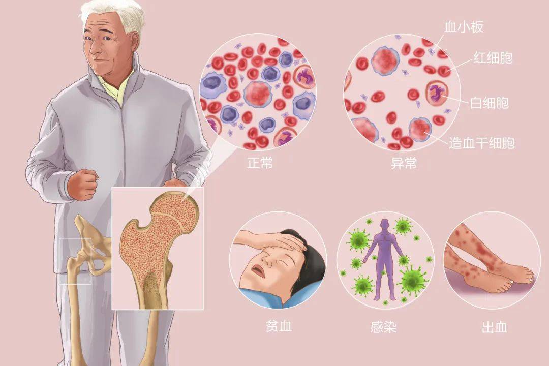 血液科谢别录:缺铁性贫血和骨髓增生异常综合征应如何护理?