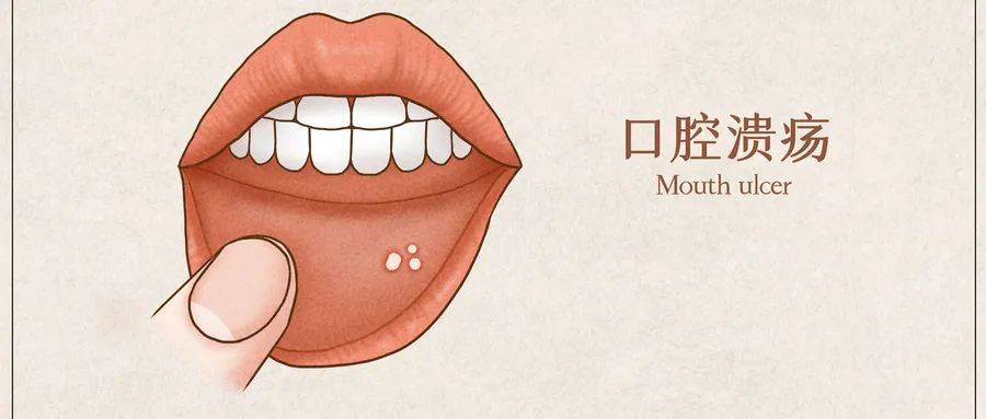 谈医论症 | 老年人反复口腔溃疡需要注意什么_黏膜_假牙_维生素