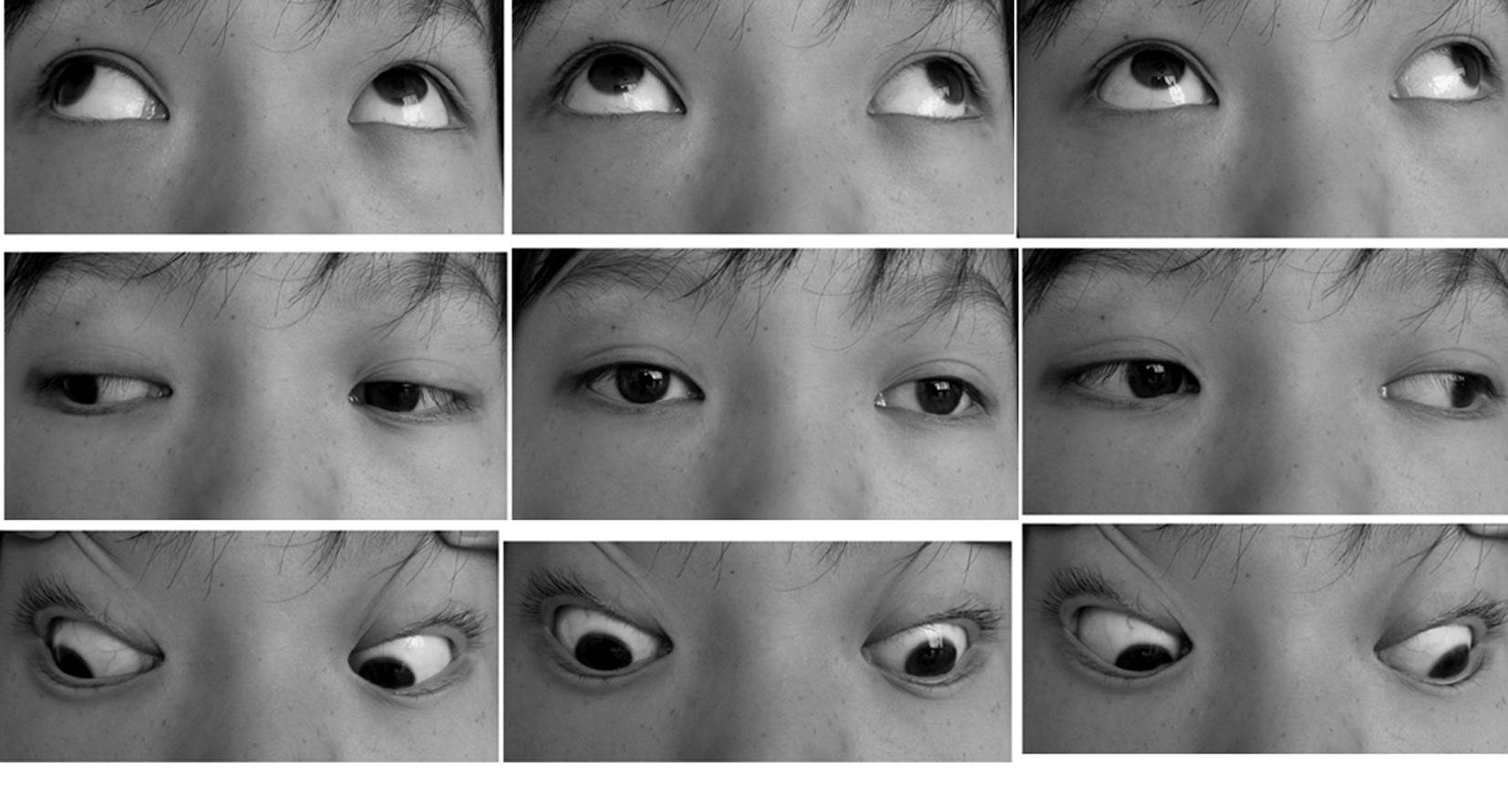 时,另一只眼出现偏斜;眼球转动时可出现不同程度受限或正常;复视现象