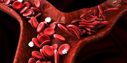 小儿贫血发病率高,占儿童四大疾病之首_红细胞_原因_缺铁性