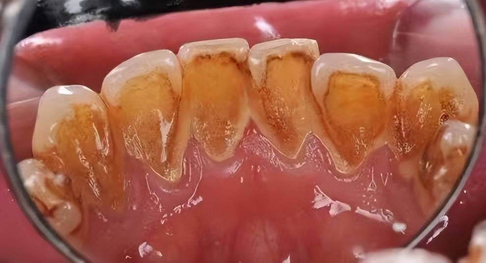 "宜柒牙粉"确实不错,不仅质地细腻,而且溶解牙石和美白牙齿效果真的好