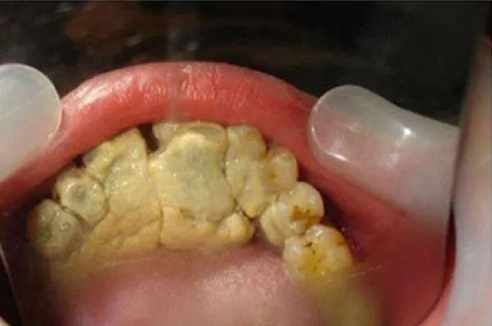 这几款过来人自用的牙粉简直是牙黄牙结石的救星!效果